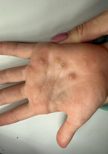 Before treatment