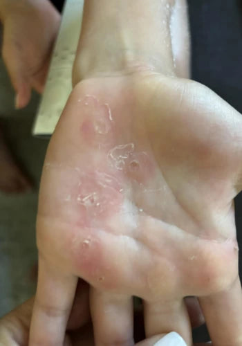 After treatment