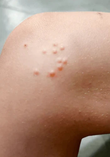 Before treatment