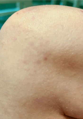 After treatment