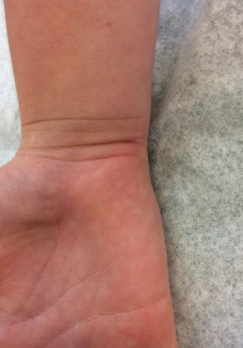 After treatment