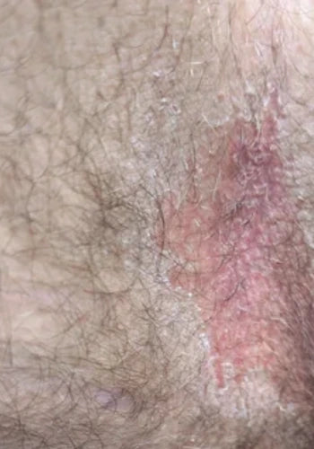 Before treatment