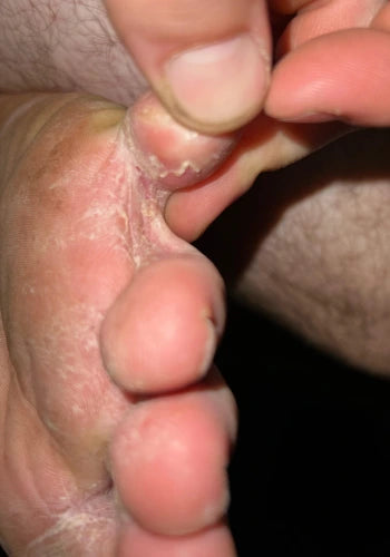 Before treatment