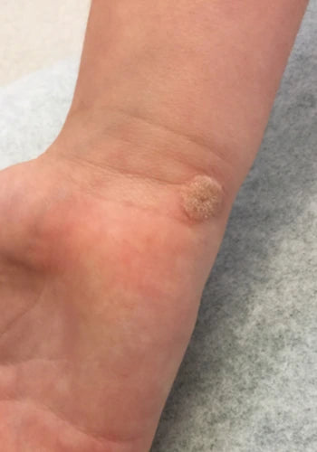 Before treatment