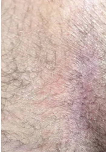 After treatment