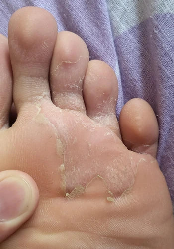 Before treatment